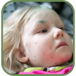 Herpes Virus