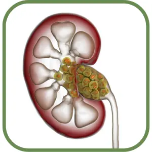 Kidney Stones